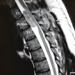 3.6厘米由T1至T3的胸椎神經線鞘腫瘤-3