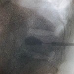 嚴重工業意外導致壓迫性脊柱椎體骨折-5