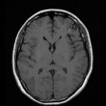 左前額大腦葉的動靜脈畸形血管瘤（AVM）流血.docx-2