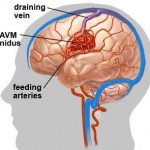 左前額大腦葉的動靜脈畸形血管瘤（AVM）流血.docx-6