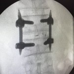腰椎間孔椎間融合術(TLIF)-3