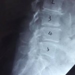 隱性的長段腰椎骨節不穩定-3