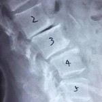 隱性的長段腰椎骨節不穩定-4