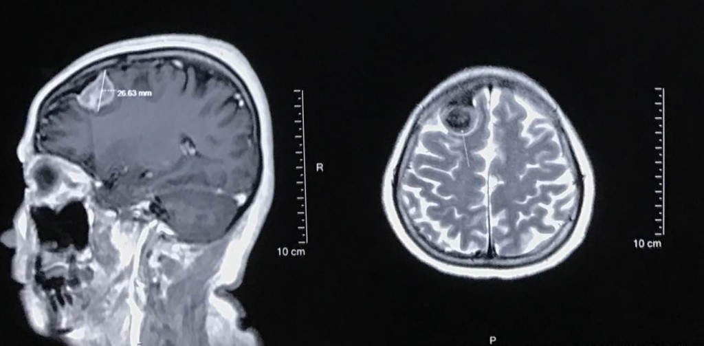 良性的腦硬膜腫瘤